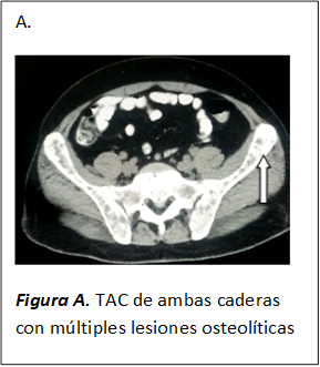 A.
 
Figura A. TAC de ambas caderas con múltiples lesiones osteolíticas

