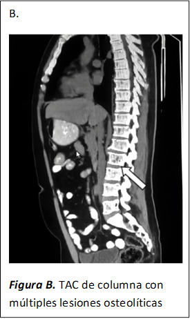 B.
 
Figura B. TAC de columna con múltiples lesiones osteolíticas

