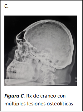 C.
 
Figura C. Rx de cráneo con múltiples lesiones osteolíticas
