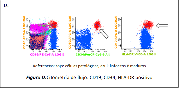 D.
 
Referencias: rojo: células patológicas, azul: linfocitos B maduros
Figura D.Citometría de flujo: CD19, CD34, HLA-DR positivo
